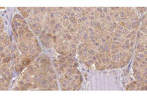 ABIN6277481 at 1/100 staining Human Melanoma tissue by IHC-P. (Neurotrophin 4 Antikörper  (Internal Region))