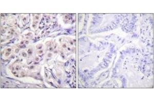 Immunohistochemistry analysis of paraffin-embedded human lung carcinoma tissue, using hnRPD (Ab-83) Antibody. (HNRNPD/AUF1 Antikörper  (AA 49-98))