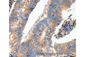 Immunohistochemistry of Human thyroid cancer using MUC6 Polyclonal Antibody at dilution of 1:40