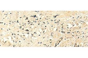 Immunohistochemistry of paraffin-embedded Human prost at e cancer tissue using MTHFS Polyclonal Antibody at dilution of 1:50(x200) (MTHFS Antikörper)