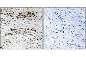 Immunohistochemistry analysis of paraffin-embedded human breast carcinoma, using Estrogen Receptor-alpha (Phospho-Ser102) Antibody. (Estrogen Receptor alpha Antikörper  (pSer102))
