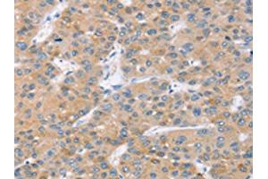 The image on the left is immunohistochemistry of paraffin-embedded Human liver cancer tissue using ABIN7131090(SLC27A2 Antibody) at dilution 1/20, on the right is treated with fusion protein. (SLC27A2 Antikörper)