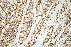 Immunohistochemistry was performed on paraffin-embedded human prostatic adenocarcinoma using arg2 antibody (ABIN7797644), 1:200). (Rekombinanter ARG2 Antikörper)