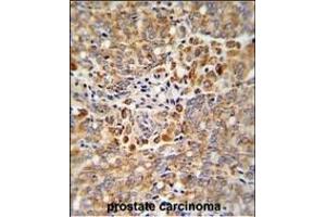 Formalin-fixed and paraffin-embedded human prostate carcinoma reacted with ALKBH3 Antibody (C-term), which was peroxidase-conjugated to the secondary antibody, followed by DAB staining.
