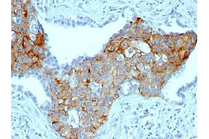 Formalin-fixed, paraffin-embedded human Lung SqCC stained with TRIM29 Mouse Monoclonal Antibody (TRIM29/1041). (TRIM29 Antikörper  (AA 1-200))