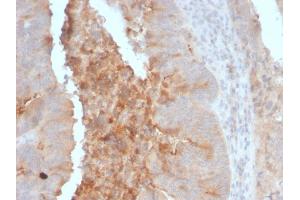 Formalin-fixed, paraffin-embedded human Colon Carcinoma stained with IgA Secretory Component Mouse Monoclonal Antibody (ECM1/792). (Rekombinanter ECM1 Antikörper)