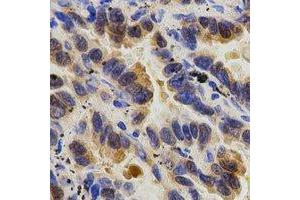 Immunohistochemical analysis of Caspase 9 p35 staining in human lung cancer formalin fixed paraffin embedded tissue section. (Caspase 9 p35 Antikörper)