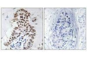 Immunohistochemistry analysis of paraffin-embedded human lung carcinoma tissue using DAPK3 (Ab-265) antibody. (DAPK3 Antikörper  (Thr265))