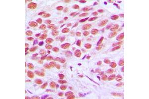 Immunohistochemical analysis of FRA2 staining in human breast cancer formalin fixed paraffin embedded tissue section. (FOSL2 Antikörper  (C-Term))