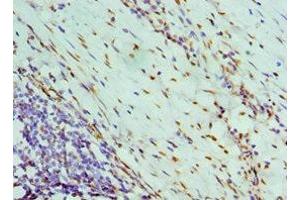 Immunohistochemistry of paraffin-embedded human colon cancer using ABIN7161690 at dilution of 1:100 (NONO Antikörper  (AA 1-300))