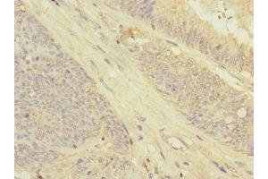 Immunohistochemistry of paraffin-embedded human colon cancer using ABIN7154564 at dilution of 1:100 (GRPEL2 Antikörper  (AA 33-225))