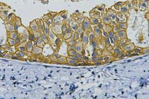 Immunohistochemistry (IHC) staining of Human Breast cancer tissue, diluted at 1:200. (ErbB2/Her2 Antikörper)