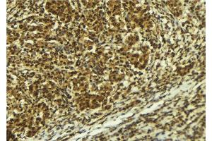 ABIN6277725 at 1/100 staining Human breast cancer tissue by IHC-P.