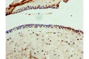 Immunohistochemistry of paraffin-embedded human breast cancer using ABIN7154159 at dilution of 1:100 (GPD1 Antikörper  (AA 1-349))