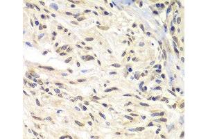 Immunohistochemistry of paraffin-embedded Human gastric cancer using CHEK1 Polyclonal Antibody at dilution of 1:100 (40x lens). (CHEK1 Antikörper)