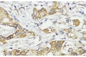 Immunohistochemistry of paraffin-embedded Human liver cancer using HACE1 Polyclonal Antibody at dilution of 1:100 (40x lens). (HACE1 Antikörper)