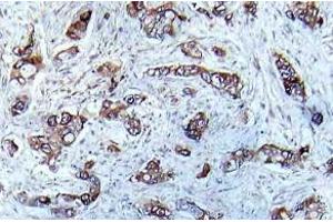 Immunohistochemistry (IHC) analyzes of p-CaMK2-a antibody in paraffin-embedded human breast carcinoma tissue. (CAMK2A Antikörper  (pThr286))