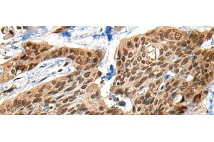 Immunohistochemistry of paraffin-embedded Human esophagus cancer tissue using XPO1 Polyclonal Antibody at dilution of 1:40(x200) (XPO1 Antikörper)