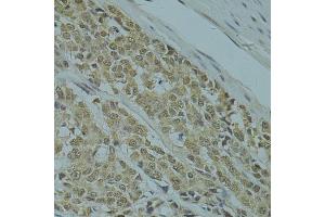 Immunohistochemistry of paraffin-embedded human colon carcinoma using RSRC1 antibody (ABIN5974341) at dilution of 1/100 (40x lens). (RSRC1 Antikörper)
