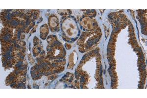 Immunohistochemistry of paraffin-embedded Human thyroid cancer using GCK Polyclonal Antibody at dilution of 1:40 (GCK Antikörper)