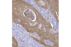 Calprotectin positive tumor cells in squamous cell carcinoma.