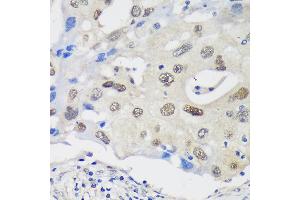 Immunohistochemistry of paraffin-embedded Human breast cancer using UCKL1 Rabbit pAb (ABIN7271233) at dilution of 1:100 (40x lens). (UCKL1 Antikörper  (AA 1-200))