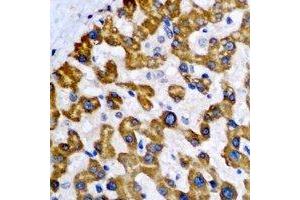 Immunohistochemical analysis of NDUFA2 staining in human liver cancer formalin fixed paraffin embedded tissue section. (NDUFA2 Antikörper)