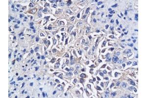 Formalin-fixed and paraffin embedded mouse hepatic tumor labeled with Anti-CD150/SLAMF1 Polyclonal Antibody, Unconjugated (ABIN749468) followed by conjugation to the secondary antibody and DAB staining (SLAMF1 Antikörper  (AA 231-335))