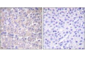 Immunohistochemistry analysis of paraffin-embedded human breast carcinoma, using EGFR (Phospho-Thr693) Antibody. (EGFR Antikörper  (pThr693))