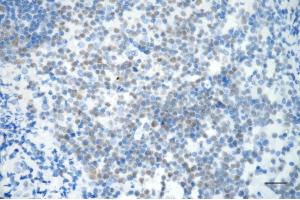 Immunohistochemistry was performed on paraffin-embedded human tonsillitis using PMS2 antibody (ABIN7799858), 1:200). (Rekombinanter PMS2 Antikörper)