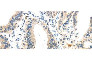 Immunohistochemistry of paraffin-embedded Human thyroid cancer using INHBB Polyclonal Antibody at dilution of 1/40 (INHBB Antikörper)