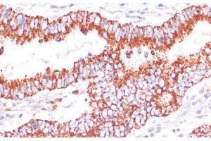 Immunohistochemistry of paraffin-embedded Human colon carcinoma using ENTPD6 Polyclonal Antibody at dilution of 1:100 (40x lens). (ENTPD6 Antikörper)