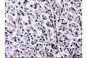 Immunohistochemical staining of paraffin-embedded Adenocarcinoma of Human colon tissue using anti-CTNNB1 mouse monoclonal antibody. (CTNNB1 Antikörper)