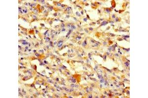 Immunohistochemistry of paraffin-embedded human melanoma using ABIN7171199 at dilution of 1:100
