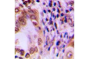 Immunohistochemical analysis of STAT1 staining in human lung cancer formalin fixed paraffin embedded tissue section.