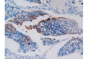 IHC-P analysis of Human Lung Cancer Tissue, with DAB staining. (c-MET Antikörper  (AA 1092-1379))