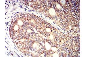 Immunohistochemical analysis of paraffin-embedded cervical cancer tissues using KIR3DL1 mouse mAb with DAB staining.