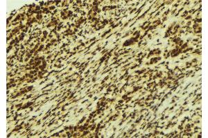 ABIN6274262 at 1/100 staining Human breast cancer tissue by IHC-P.