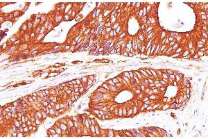 Immunohistochemistry of paraffin-embedded Human carcinoma of Colon using Sptan1 Polyclonal Antibody at dilution of 1:100(400x) (SPTAN1 Antikörper)
