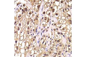 Immunohistochemistry of paraffin-embedded human kidney cancer using TCEB3 antibody at dilution of 1:100 (x400 lens). (TCEB3 Antikörper)