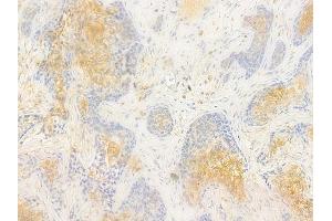 ABIN7096990 and ABIN7101057 at 1/100 staining human breast carcinoma by IHC-P. (ADSSL1 Antikörper)
