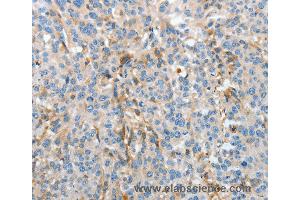 Immunohistochemistry of Human esophagus cancer using APOH Polyclonal Antibody at dilution of 1:30 (APOH Antikörper)