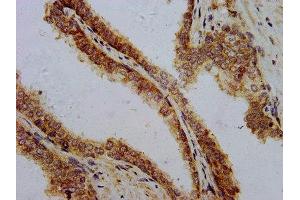IHC image of ABIN7162643 diluted at 1:700 and staining in paraffin-embedded human prostate cancer performed on a Leica BondTM system. (PTH Antikörper  (AA 32-115))