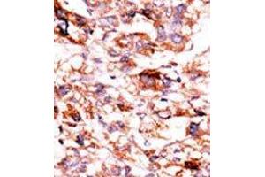 Formalin-fixed and paraffin-embedded human cancer tissue reacted with the primary antibody, which was peroxidase-conjugated to the secondary antibody, followed by AEC staining. (ADCK5 Antikörper  (C-Term))