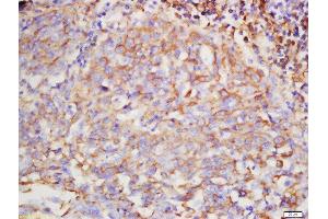 Formalin-fixed and paraffin embedded human lung carcinoma labeled with Rabbit Anti-Hyaluronidase2 Polyclonal Antibody, Unconjugated  at 1:200 followed by conjugation to the secondary antibody and DAB staining (HYAL2 Antikörper  (AA 111-210))