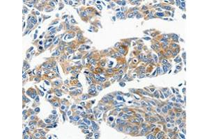 Immunohistochemical analysis of paraffin-embedded Human lung cancer tissue using at dilution 1/50. (CCL23 Antikörper  (C-Term))