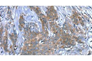 Immunohistochemistry of paraffin-embedded Human cervical cancer using SCPEP1 Polyclonal Antibody at dilution of 1:30 (SCPEP1 Antikörper)