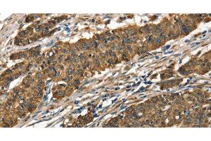 Immunohistochemistry of paraffin-embedded Human gastic cancer using Cathepsin E Polyclonal Antibody at dilution of 1:40