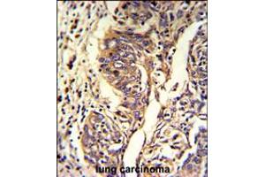 Formalin-fixed and paraffin-embedded human lung carcinoma reacted with KYNU Antibody , which was peroxidase-conjugated to the secondary antibody, followed by DAB staining. (KYNU Antikörper  (C-Term))