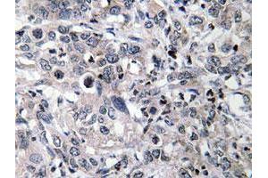 Immunohistochemical analysis of paraffin-embedded human liver carcinoma tissue using CYP2C19 polyclonal antibody . (CYP2C19 Antikörper)